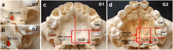Morphological analysis of the greater palatine foramen in babies and children: anesthetic and surgical approach - Anatomical Science International