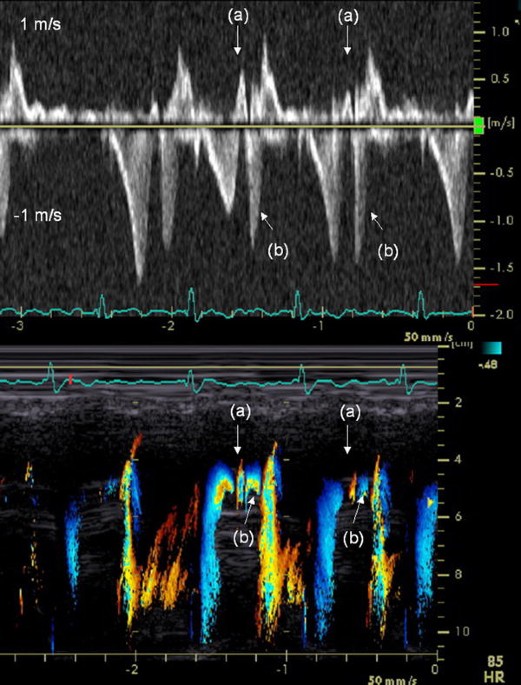 Mid-systolic flow reversal in a patient with mid-ventricular obstructive  hypertrophic cardiomyopathy | Journal of Echocardiography