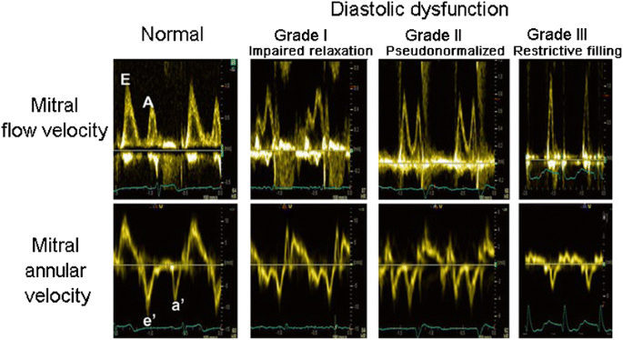 Should We Test for Diastolic Dysfunction? How and How Often