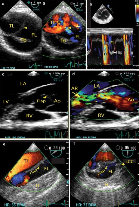 Perioperative transesophageal echocardiography for aortic dissection |  Canadian Journal of Anesthesia/Journal canadien d'anesthésie