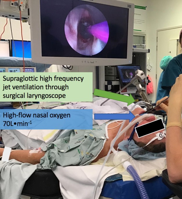 Combination of transnasal humidified rapid-insufflation ventilatory  exchange with high frequency jet ventilation for shared airway surgery |  Canadian Journal of Anesthesia/Journal canadien d'anesthésie