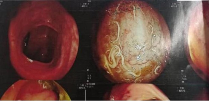 Massive ileocolic ascariasis mimicking Crohn’s disease and revealing lymphocytic colitis in a type 1 diabetic adolescent: a case report