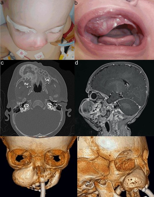Melanotic Neuroectodermal Tumour of Infancy: Clinical Courses and  Therapeutic Options—A Review of Three Cases | Journal of Maxillofacial and  Oral Surgery