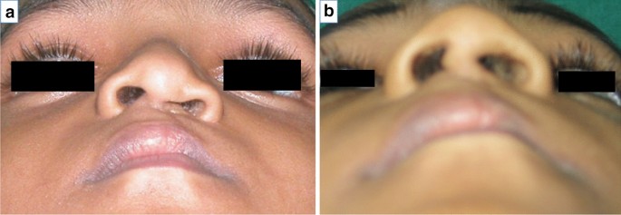 Management of the Nasal Deformity in the Unilateral Cleft of the Lip and  Nose | Journal of Maxillofacial and Oral Surgery