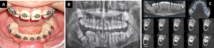 Sagittal Split Osteotomy of the Mandibular Ramus for Removal of “Kissing” Molars: A Case Report - Journal of Maxillofacial and Oral Surgery