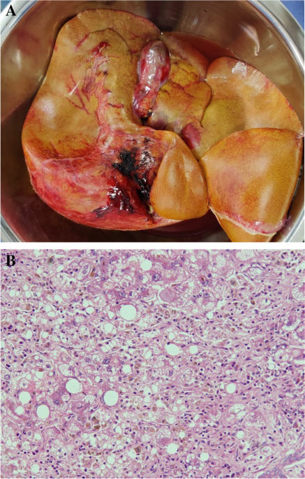Liver poisoning due to yellow phosphorus from rat poison