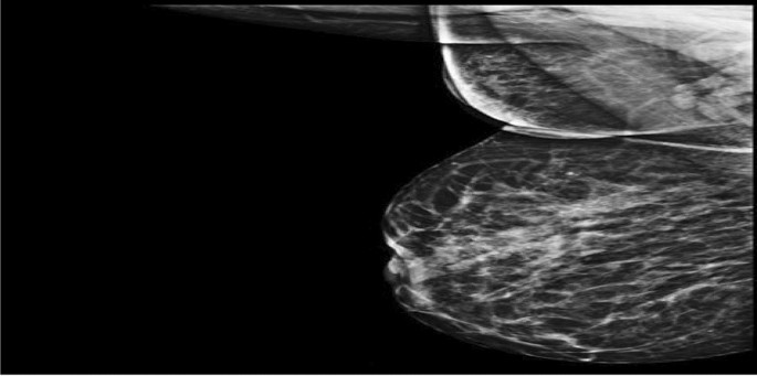 A review on machine learning techniques for the assessment of image grading  in breast mammogram