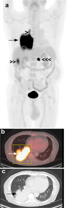 18 F-FDG PET/CT Metabolic Parameters Add Prognostic Information to Stage IV Classification in Patients with Non-Small Cell Lung Cancer