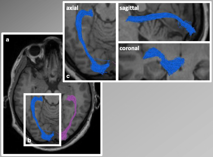 Measuring Connectivity in the Primary Visual Pathway in Human Albinism  Using Diffusion Tensor Imaging and Tractography