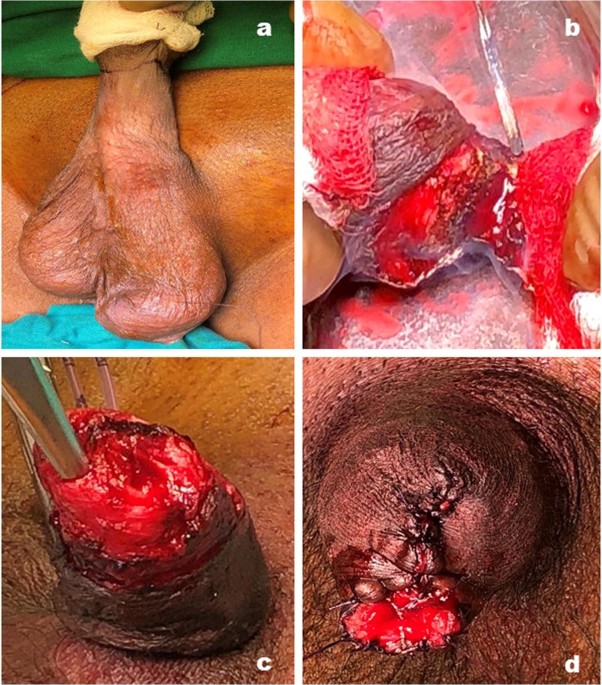 Modified Inguinal Lymph Node Dissection in Groin-Negative Patients of  Penile Cancer: Our Experience | Indian Journal of Surgical Oncology