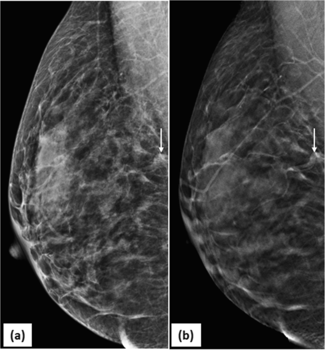 Eur J Breast Health on X: Accurate Estimation of Breast Tumor