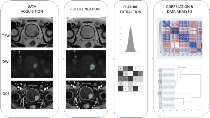 Multiparametric MRI Radiomics for the Prediction of Histologic Grade in Bladder Cancer