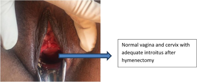 Microperforate Hymen in a Primigravida in Second Trimester with Anomalous  Fetus | The Journal of Obstetrics and Gynecology of India