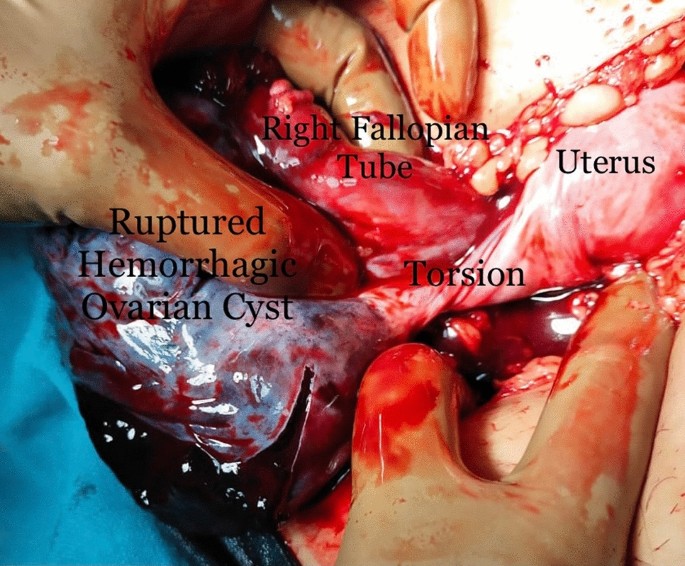 Atypical Presentation of a Giant Hemorrhagic Ovarian Cyst