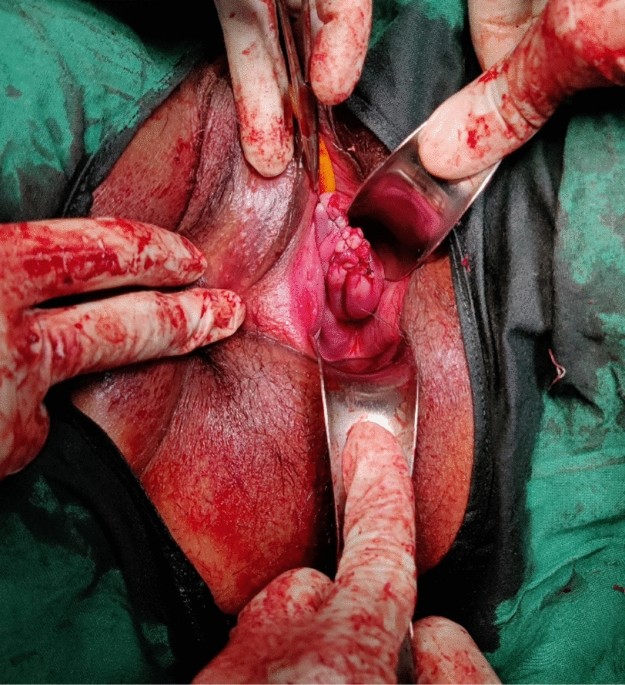 Cureus, A Rare Case of Posterior Vaginal Wall Gartner's Duct Cyst  Mimicking as Genital Prolapse