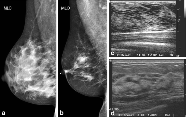 Breast disease in the pregnant and lactating patient: radiological