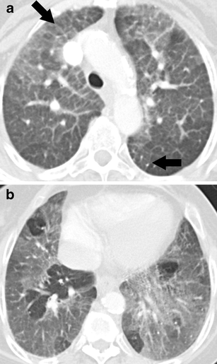 Niemann-Pick disease type B: HRCT assessment of pulmonary