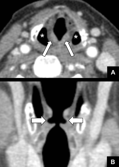 Vocal cord paralysis: anatomy, imaging and pathology | Insights into  Imaging | Full Text