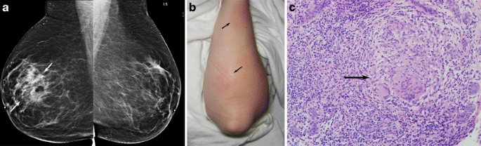 A 34-year-old pregnant patient with area of redness and pain left