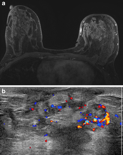 Idiopathic granulomatous mastitis: imaging update and review