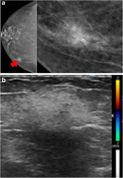 Granulomatous diseases of the breast and axilla: radiological findings with  pathological correlation, Insights into Imaging