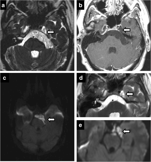 Marginal mandibular nerve, Radiology Reference Article