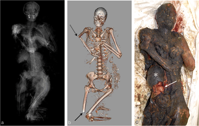 Burned bodies: post-mortem computed tomography, an essential tool for  modern forensic medicine | Insights into Imaging | Full Text