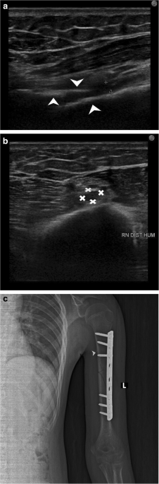 Nerve entrapment syndromes of the upper limb: a pictorial review, Insights  into Imaging