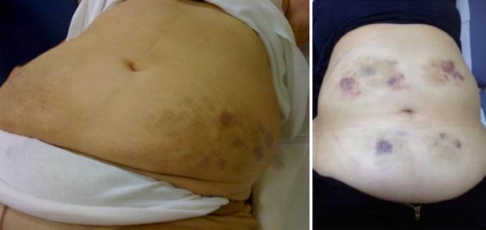 bruising at glp 1 injection site Lipodystrophy in Insulin-Treated Subjects and Other Injection-Site Skin  Reactions: Are We Sure Everything is Clear? | Diabetes Therapy