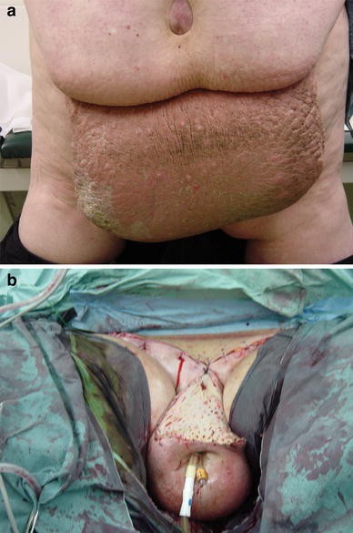 Pseudosarcoma – massive localized lymphoedema in morbidly obese – a rare  entity: Case report - ScienceDirect