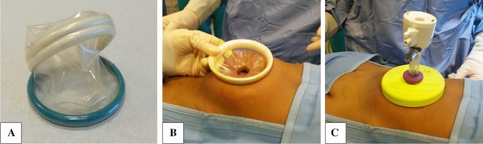 PDF] Severe Hypotension Associated with Insertion of an Alexis ® Wound  Protector / Retractor during Lower Abdominal Surgery in a Child : A Case  Report | Semantic Scholar