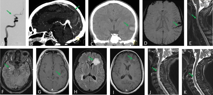 Therapeutic Approaches to the Neurologic Manifestations of COVID-19 | Neurotherapeutics