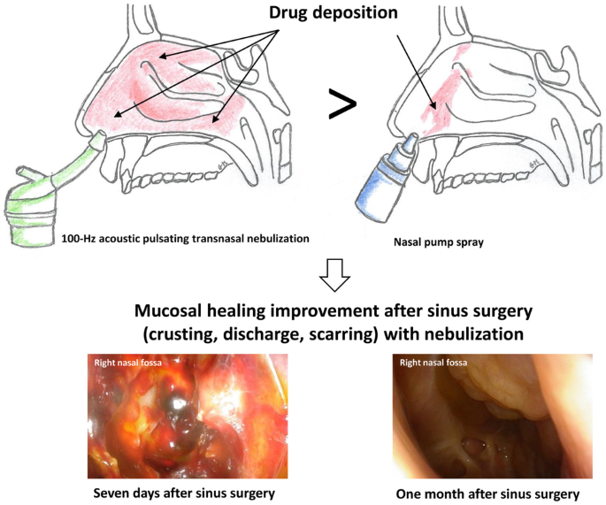 Budesonide transnasal pulsating nebulization after surgery in chronic  rhinosinusitis with nasal polyps | Drug Delivery and Translational Research