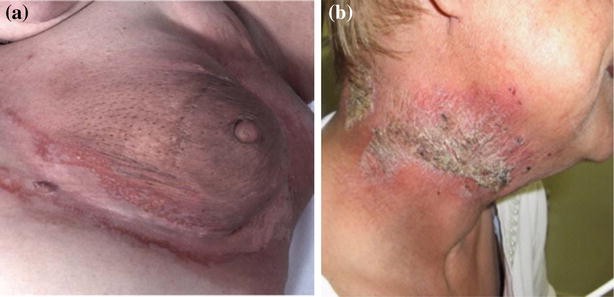 Acute and Chronic Cutaneous Reactions to Ionizing Radiation