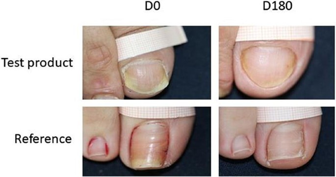 Amorolfine Medicated Nail Liquer 5% *POM*