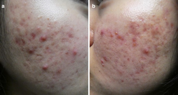 Acne Vulgaris: A Patient and Physician's Experience | Dermatology and  Therapy