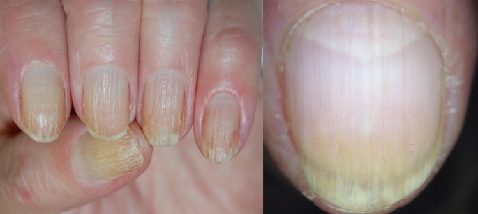 Figure 2 from Diagnosis using the nail bed and hyponychium. | Semantic  Scholar