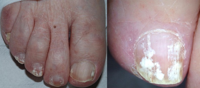 Causes of White Spots on Toenails