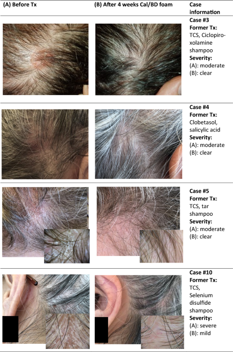 Efficacy of Calcipotriol/Betamethasone Dipropionate Fixed-Combination  Aerosol Foam in the Treatment of Localized Scalp Psoriasis: A Real-Life  Case Series from Switzerland | Dermatology and Therapy