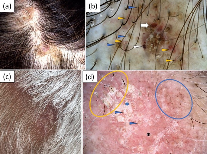 Chronic Cutaneous Lupus Erythematosus In A White Potion Dermoscopic Characteristics By Clinical Subtype Lesion Location And Disease Duration Dermatology Therapy