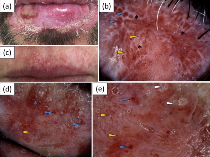 Chronic Cutaneous Lupus Erythematosus In A White Potion Dermoscopic Characteristics By Clinical Subtype Lesion Location And Disease Duration Dermatology Therapy