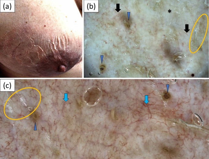 Chronic Cutaneous Lupus Erythematosus In A White Potion Dermoscopic Characteristics By Clinical Subtype Lesion Location And Disease Duration Dermatology Therapy