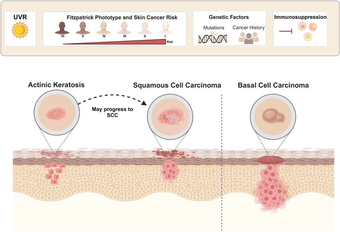 Biomarkers in Cutaneous Keratinocyte Carcinomas