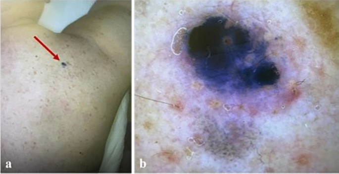 melanotic carcinoma Tumoral Melanosis: A Case Series of a Rare Clinical Entity | Dermatology  and Therapy