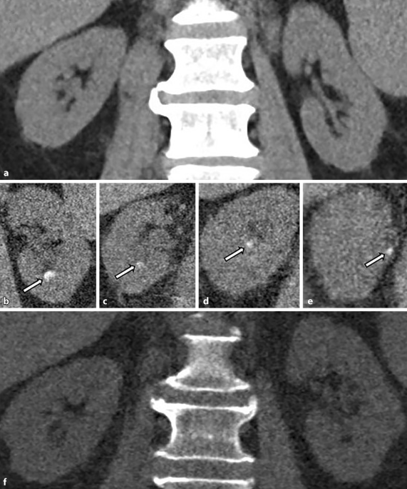 Case report. Urolithiase bij patiënten met tumorlysissyndroom: valkuilen vanuit een urologisch perspectief
