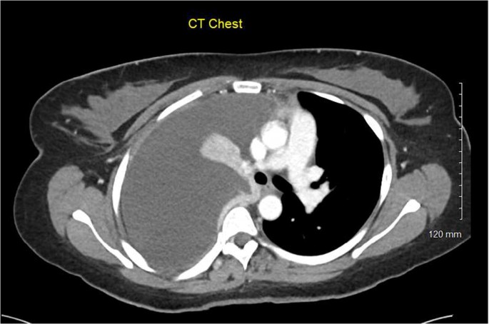 A case report of thoracic endometriosis – A rare cause of