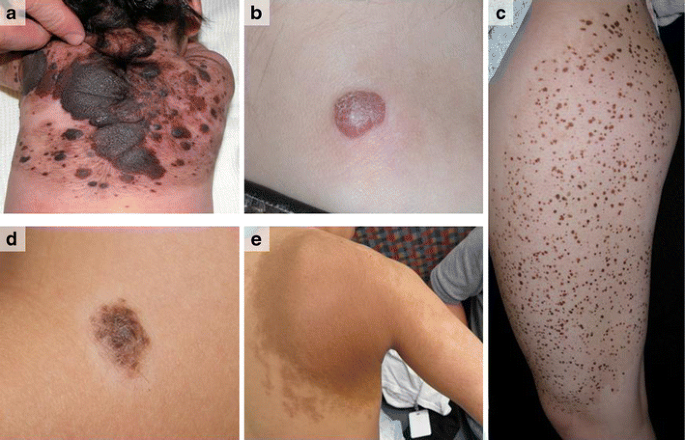 Literature Update on Melanocytic Nevi and Pigmented Lesions in the  Pediatric Population | Current Dermatology Reports | Springer Nature Link
