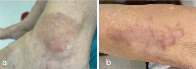 Granuloma Annulare: A Clinical Update | Current Dermatology Reports | Springer Nature Link