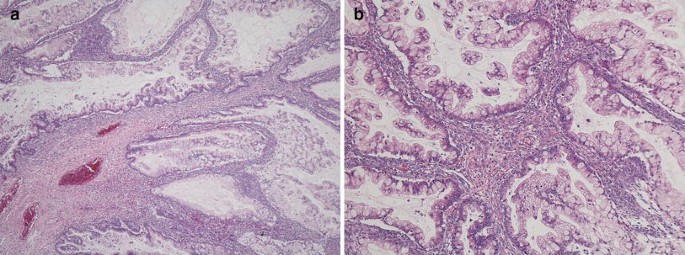 PDF) Factors associated with misdiagnosis of frozen section of mucinous  borderline ovarian tumor