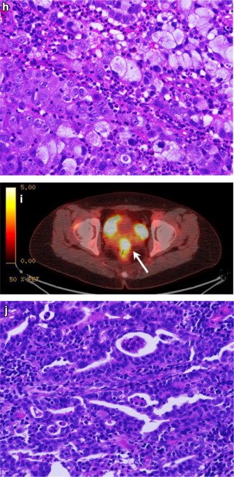 Signet ring cell carcinoma - Libre Pathology